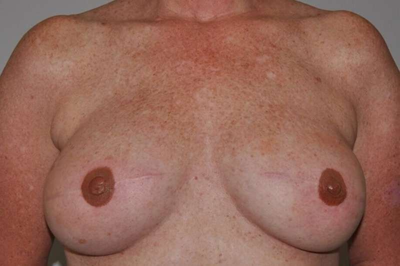 DIEP Flap Before & After Patient #3058