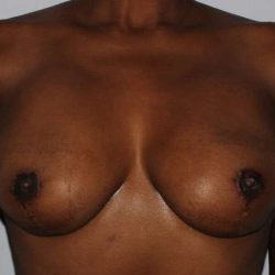 DIEP Flap Before & After Patient #3061