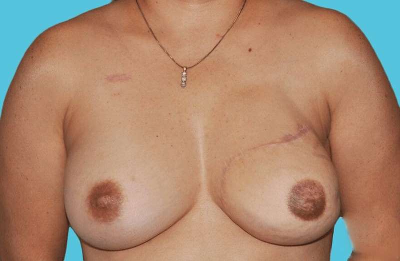 DIEP Flap Before & After Patient #3064