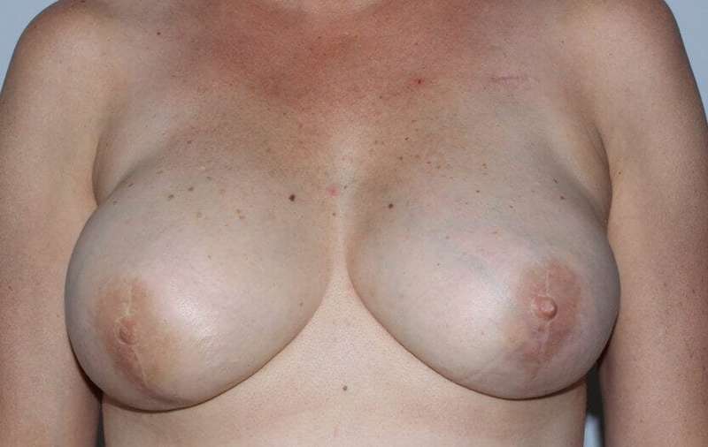 DIEP Flap Before & After Patient #3067