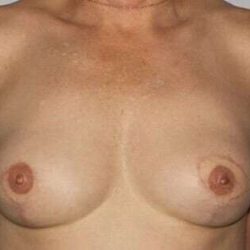 DIEP Flap Before & After Patient #3070