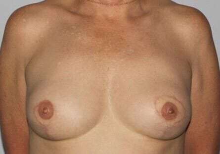 DIEP Flap Before & After Patient #3070