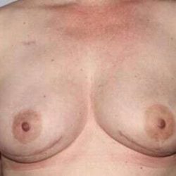 DIEP Flap Before & After Patient #3073
