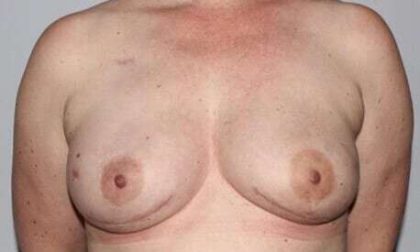 DIEP Flap Before & After Patient #3073