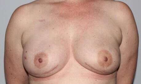 DIEP Flap Before & After Patient #3073
