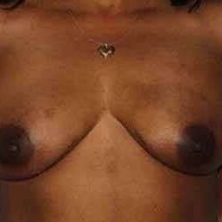 DIEP Flap Before & After Patient #3077
