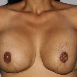 DIEP Flap Before & After Patient #3080