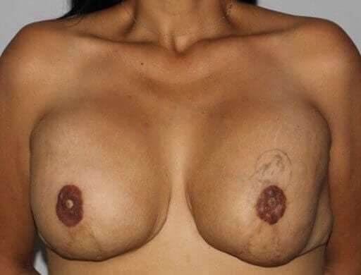 DIEP Flap Before & After Patient #3080