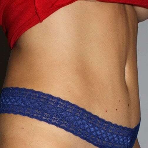 Abdominoplasty (Tummy Tuck) Before & After Patient #848
