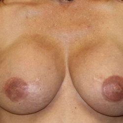 DIEP Flap Before & After Patient #3083