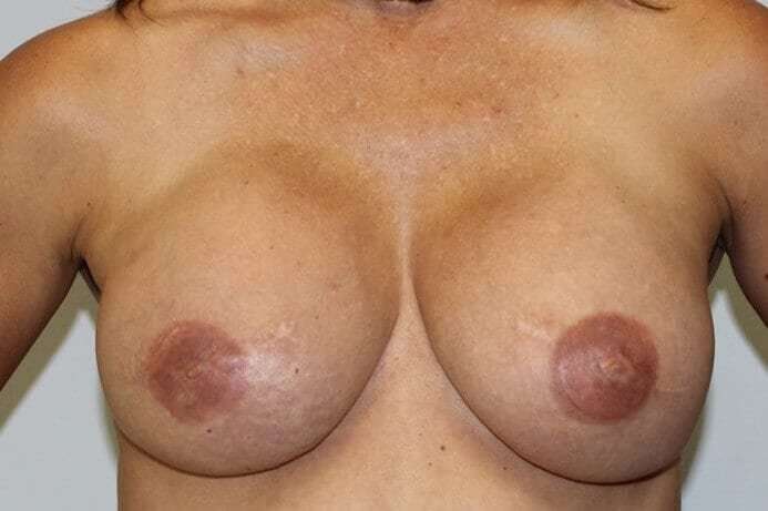 DIEP Flap Before & After Patient #3083