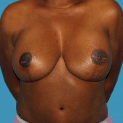 DIEP Flap Before & After Patient #3086