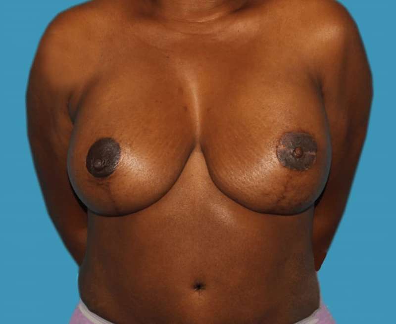 DIEP Flap Before & After Patient #3086