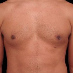 Gynecomastia Before & After Patient #3130