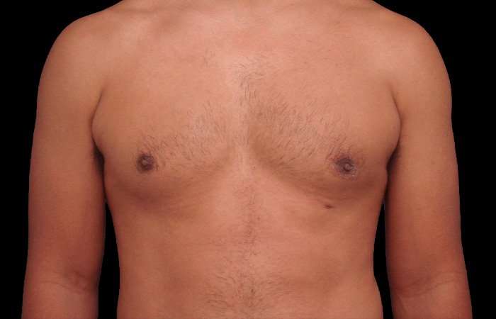 Gynecomastia Before & After Patient #3130
