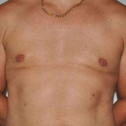 Gynecomastia Before & After Patient #3135