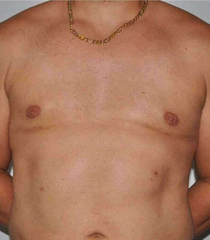 Gynecomastia Before & After Patient #3135