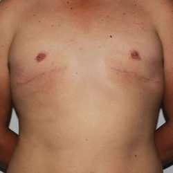 Gynecomastia Before & After Patient #3140