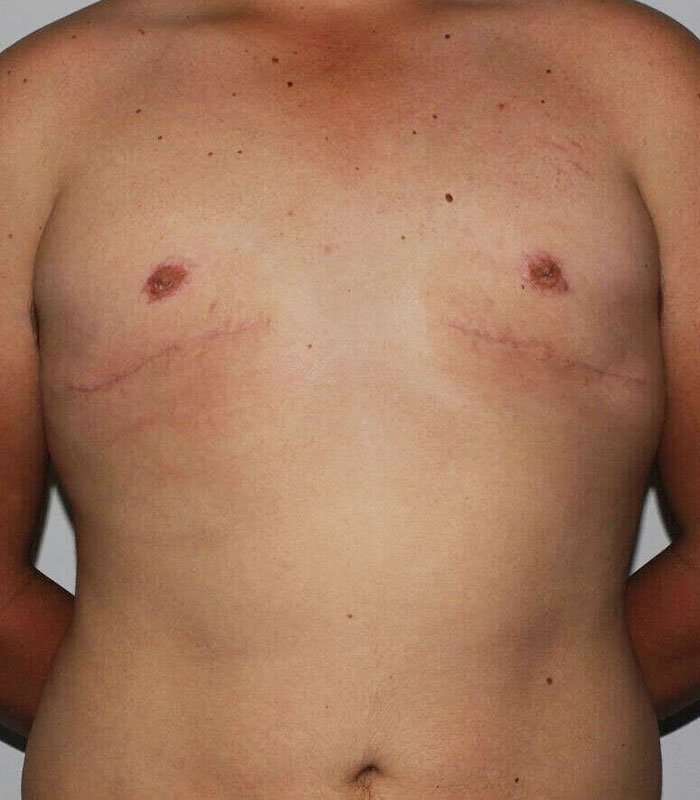 Gynecomastia Before & After Patient #3140