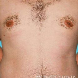 Gynecomastia Before & After Patient #3145