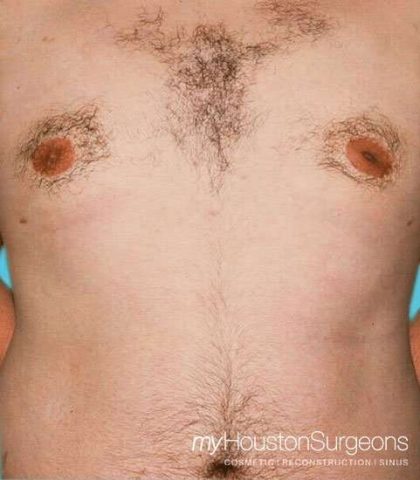 Gynecomastia Before & After Patient #3145
