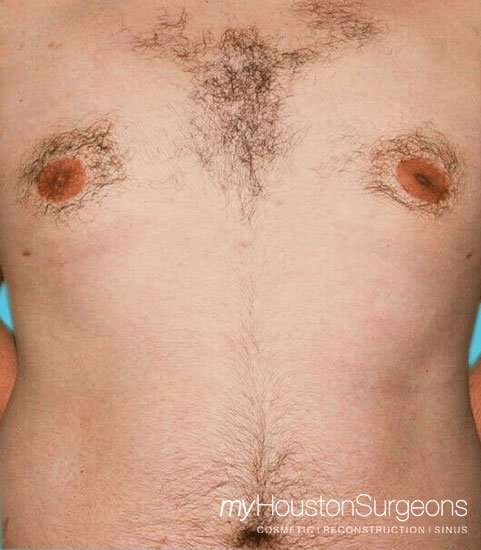 Gynecomastia Before & After Patient #3145