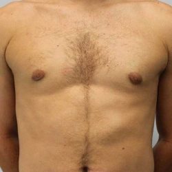 Gynecomastia Before & After Patient #3151