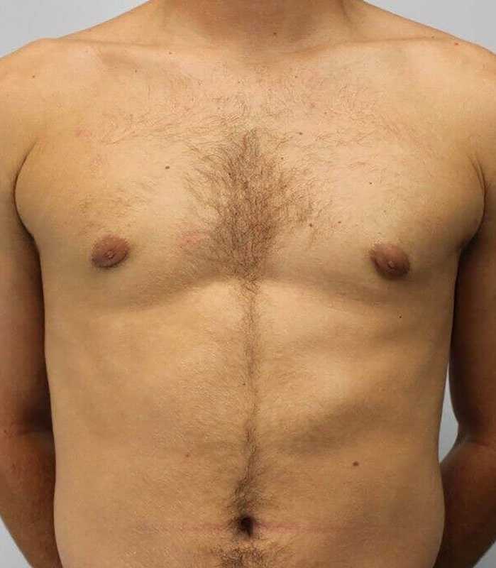 Gynecomastia Before & After Patient #3151