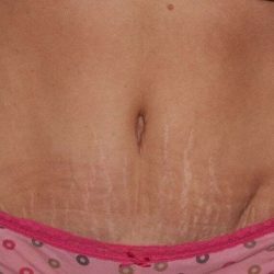 Abdominoplasty (Tummy Tuck) Before & After Patient #855