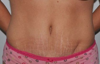 Abdominoplasty (Tummy Tuck) Before & After Patient #855
