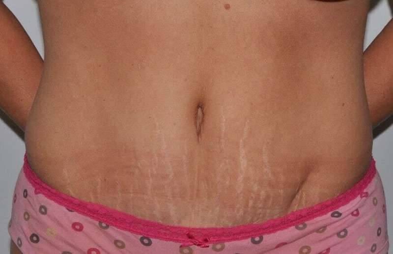 Abdominoplasty (Tummy Tuck) Before & After Patient #855