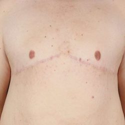 Gynecomastia Before & After Patient #3162