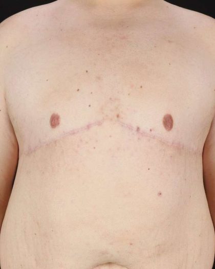 Gynecomastia Before & After Patient #3162