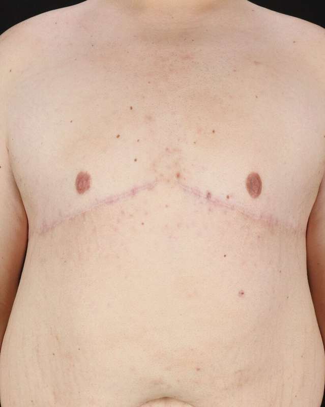 Gynecomastia Before & After Patient #3162