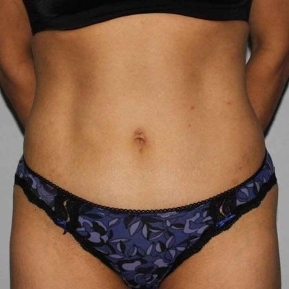 Abdominoplasty (Tummy Tuck) Before & After Patient #862