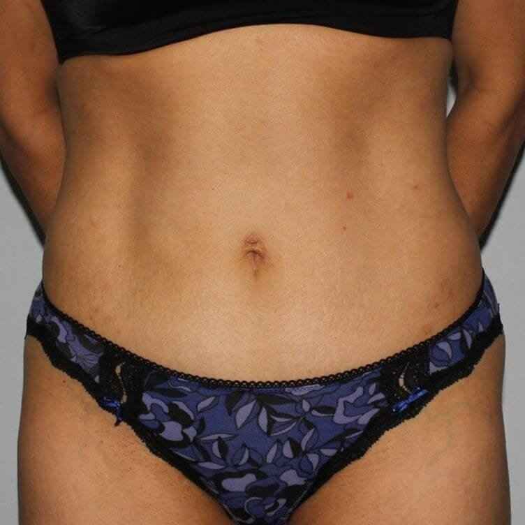Abdominoplasty (Tummy Tuck) Before & After Patient #862