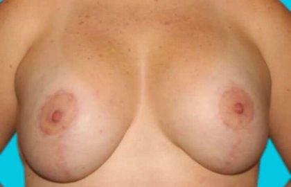 Mastopexy Before & After Patient #3251