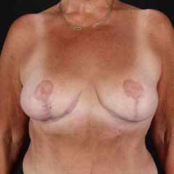 Breast Reduction With Lift Before & After Patient #3312