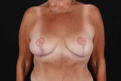 Breast Reduction With Lift Before & After Patient #3312
