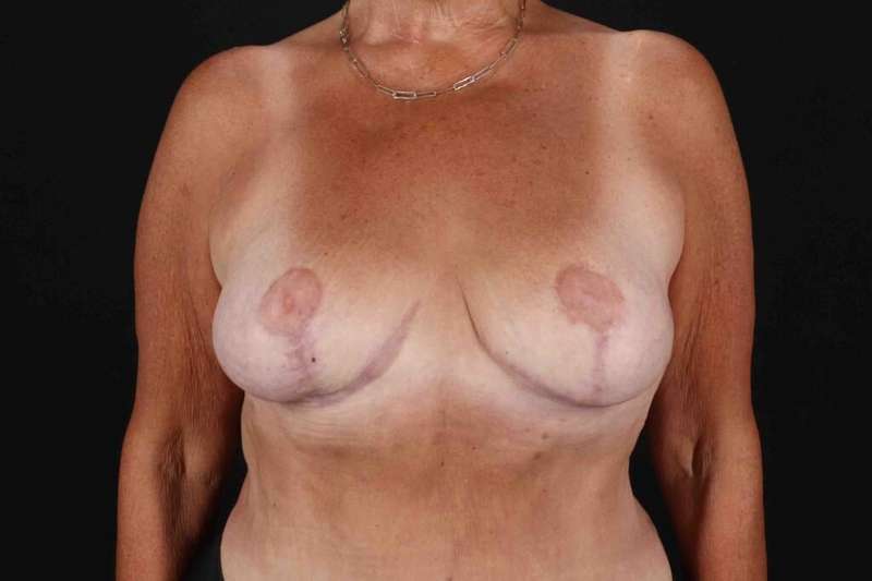 Breast Reduction With Lift Before & After Patient #3312