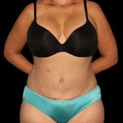 Abdominoplasty (Tummy Tuck) Before & After Patient #579