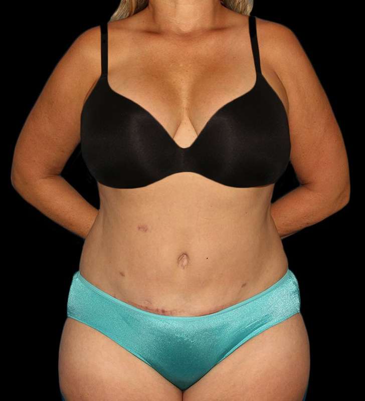 Abdominoplasty (Tummy Tuck) Before & After Patient #579