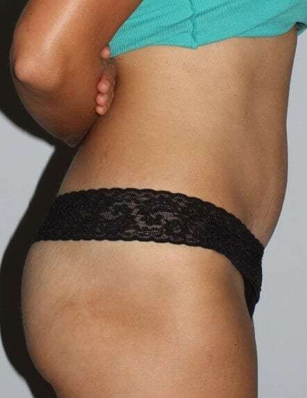 Abdominoplasty (Tummy Tuck) Before & After Patient #867