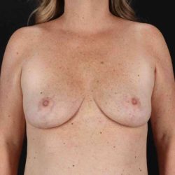 Breast Reduction With Lift Before & After Patient #3345