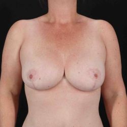 Breast Reduction With Lift Before & After Patient #3356