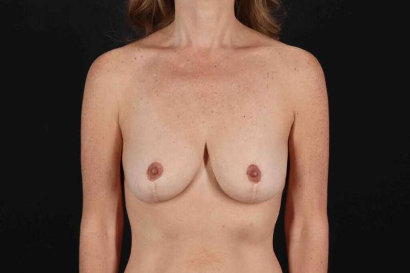 Breast Reduction With Lift Before & After Patient #3389