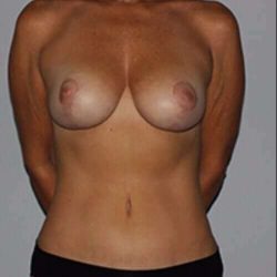 Breast Reduction With Lift Before & After Patient #3440
