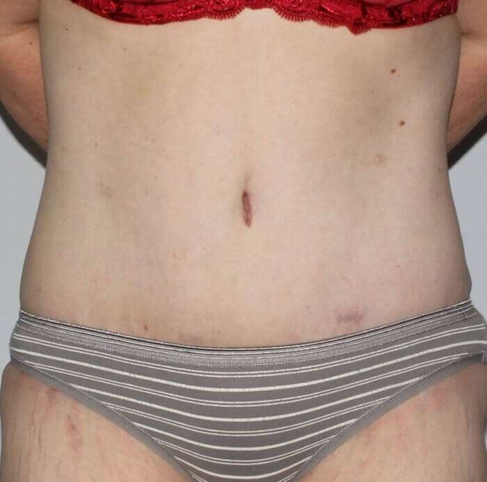Abdominoplasty (Tummy Tuck) Before & After Patient #874