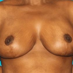 Breast Reduction With Lift Before & After Patient #3443