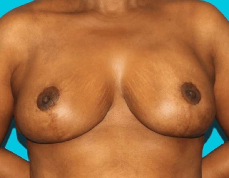 Breast Reduction With Lift Before & After Patient #3443